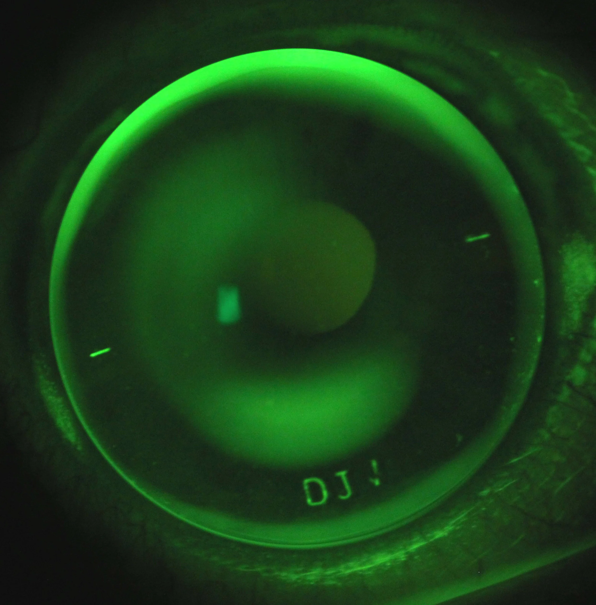 A customised corneal rigid lens for a patient with  keratoconus , viewed under green light.