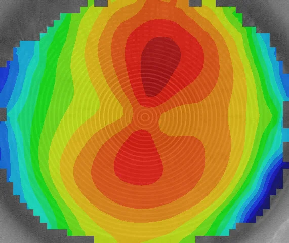 A graphical representation of the eye shape of a patient with astigmatism. Information like this is crucial when we design customised contact lenses at Bay Eye Care.