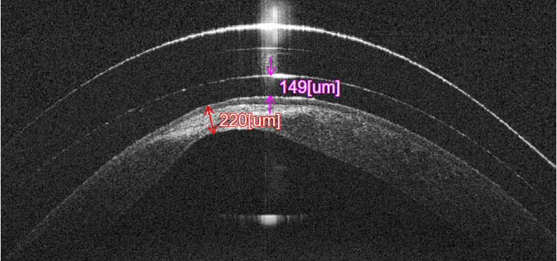 An OCT scan showing a scleral rigid lens fitting over a patient with a central corneal scar. You can see the contact lens does not touch the eye in this location.