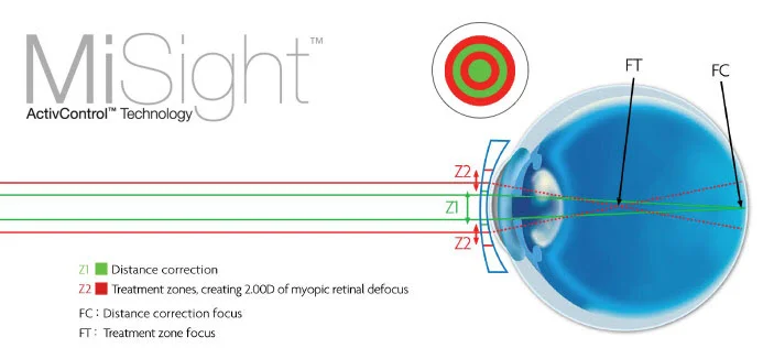The design of the Misight myopia control soft contact lens.