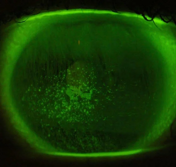 Dry eye as viewed with a special diagnostic dye. The speckled surface is where the eye has been damaged due to drying out.