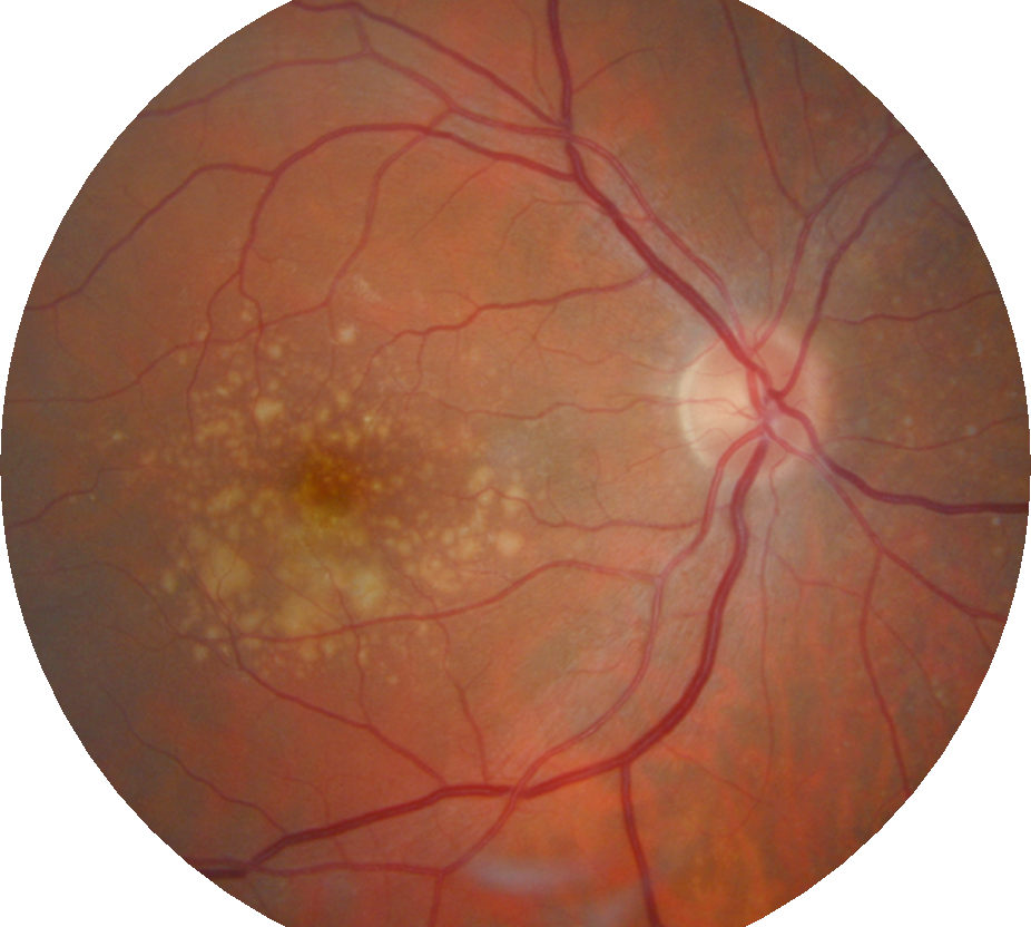 An eye with macular degeneration. Note the yellow debris or 'drusen' in the centre of the retina.