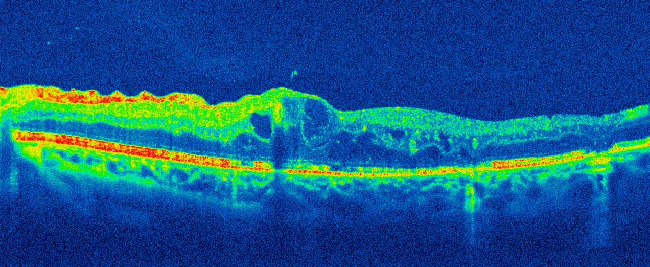 An OCT scan of a diabetic with swelling in their retina due to poor control of blood sugar levels. Normally the retina is smooth and even with no blue spaces (fluid).