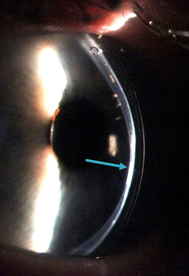 An eye with moderate keratoconus fitted with a rigid scleral contact lens. You can see the contact lens dimly to the right of the cornea. The blue arrows shows the thinned and scarred corneal tissue.