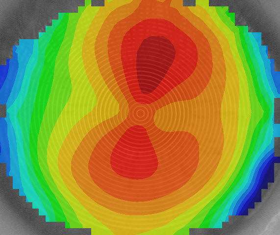 Corneal Topography of Astigmatism