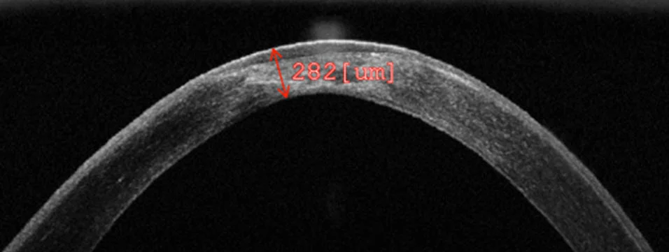 OCT of Cornea with Keratoconus