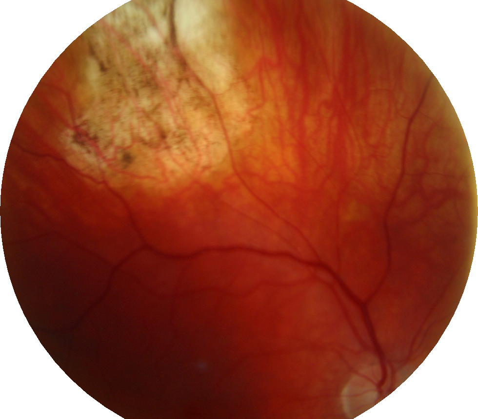 Retinal Image of Scars Following Retinal Detachment