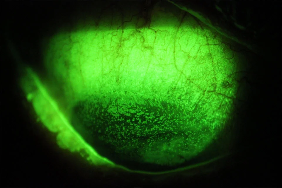 Image of a Cornea with Dry Eye