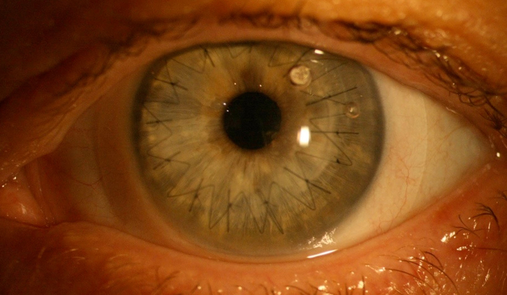 corneal graft with scleral lens.jpg