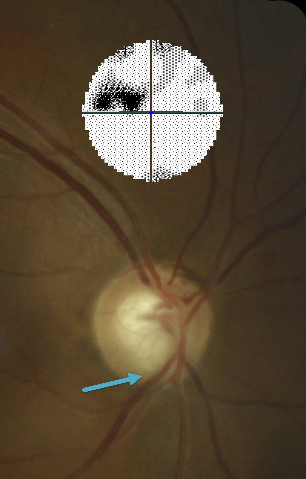 Image of a Optic Nerve with Glaucoma