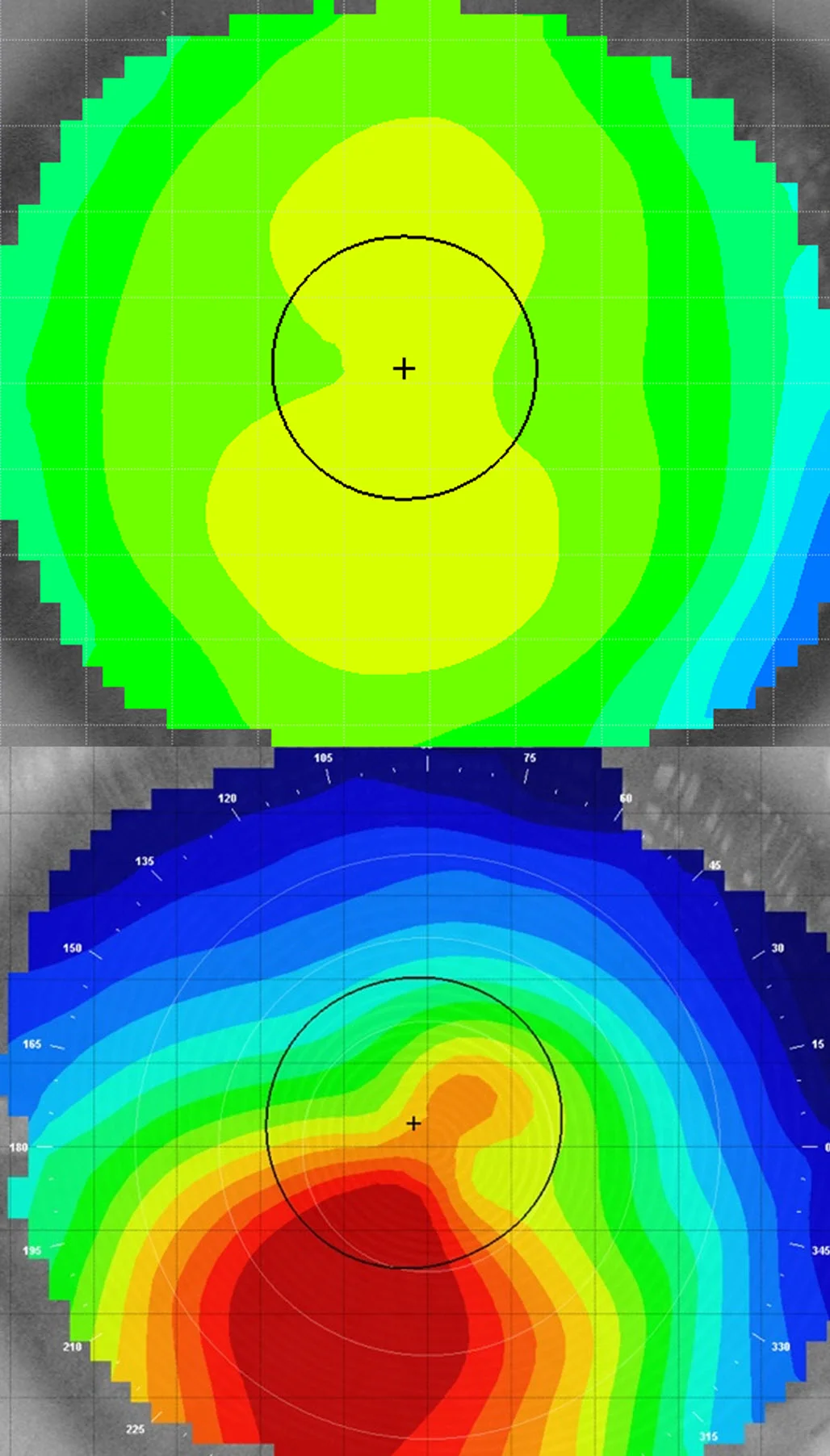 Corneal Topography of Keratoconus