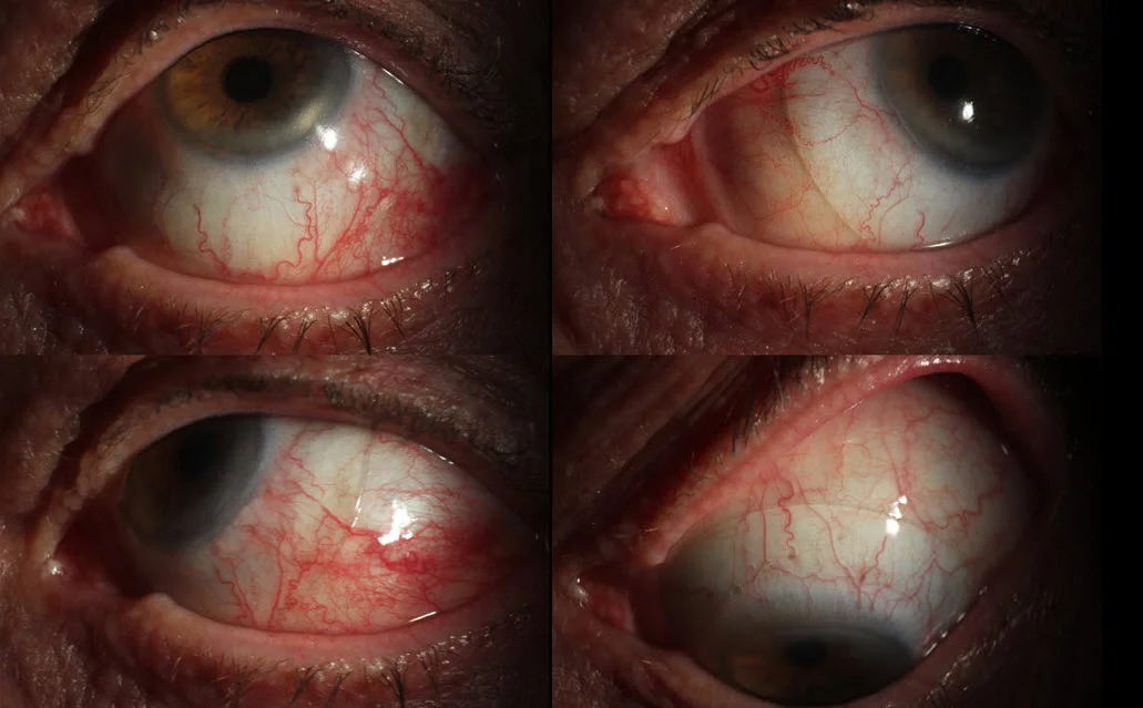 Scleral Lens for Dry Eye