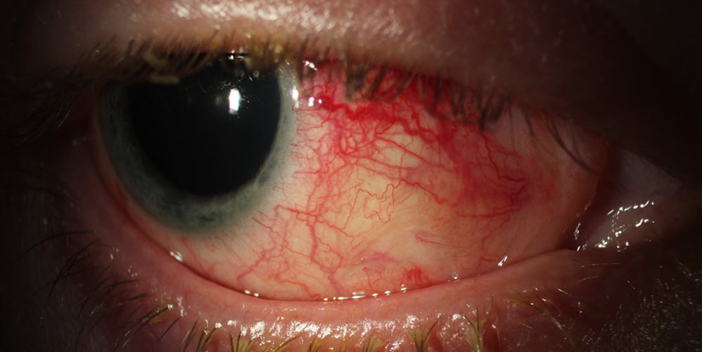 Eye with Inflammation