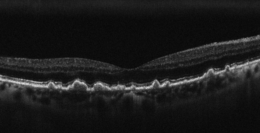 OCT of Age-related Macular Degeneration