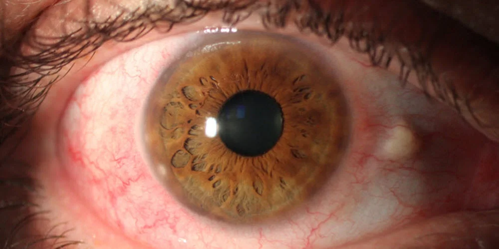 A painful corneal inflammation that required urgent topical medication to resolve.