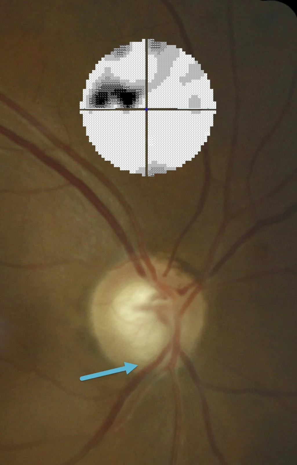 The optic nerve of a person with glaucoma. The blue arrow shows the damaged area of the optic nerve. The black blotches in the graphic shows the vision loss in the top half of this person's sight.