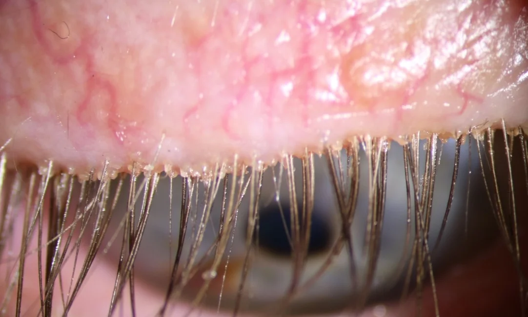 Bay Eye Care — Dry Eye & Blepharitis