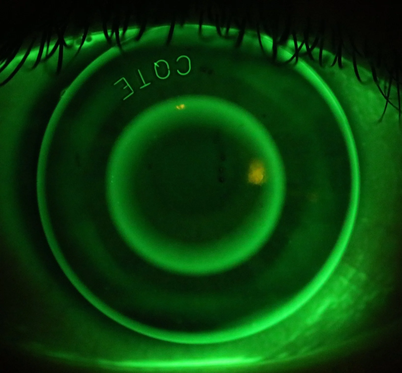 David's Ortho-K lens photographed on his eye.