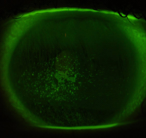 The green speckled area shows a patch of dryness on the surface of an eye with MGD