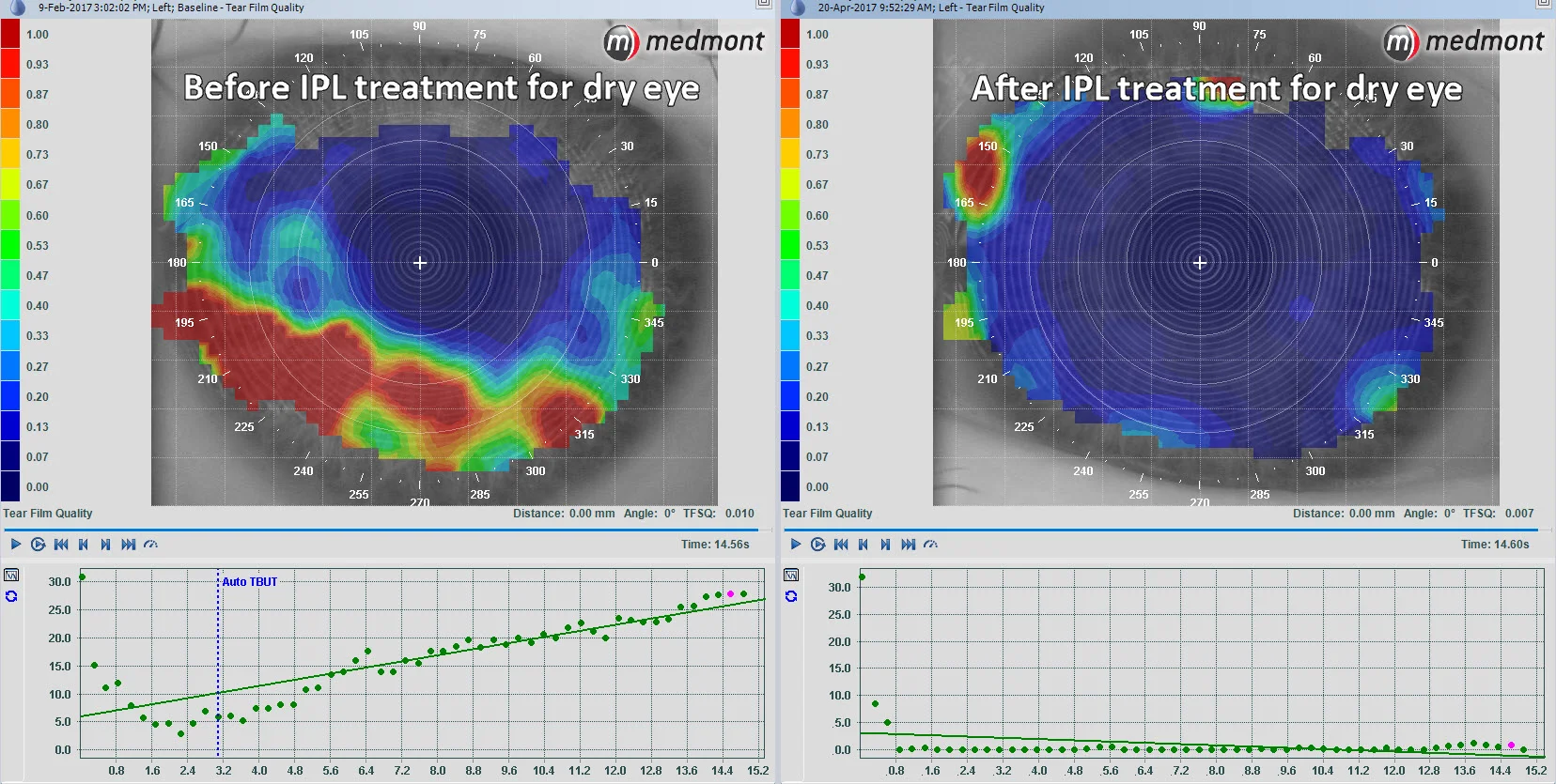 Before treatment this patient's eye took only 3 seconds to start drying out as measured by automated tear film analysis. After treatment the tears are completely stable after 15 seconds!