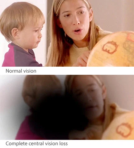 How your vision can look with AMD. (From Macular Degeneration NZ, www.mdnz.org.nz)