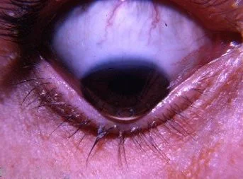 Keratoconus bay eye care