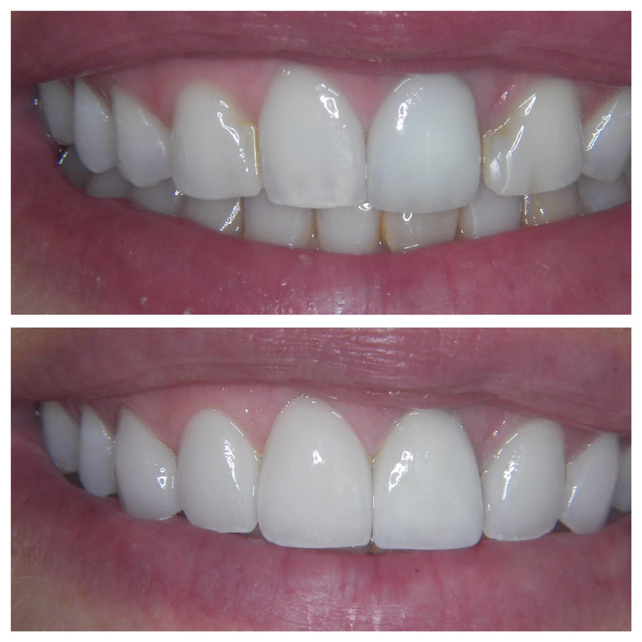 28 y.o. Female Treated With 6 Laminates