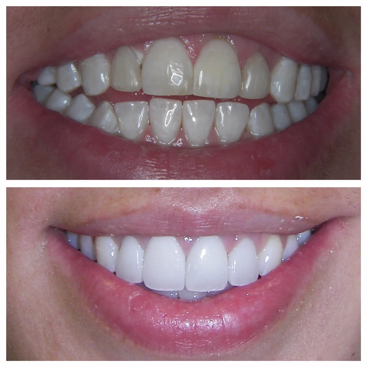 30 y.o. Female Treated With 6 Laminates