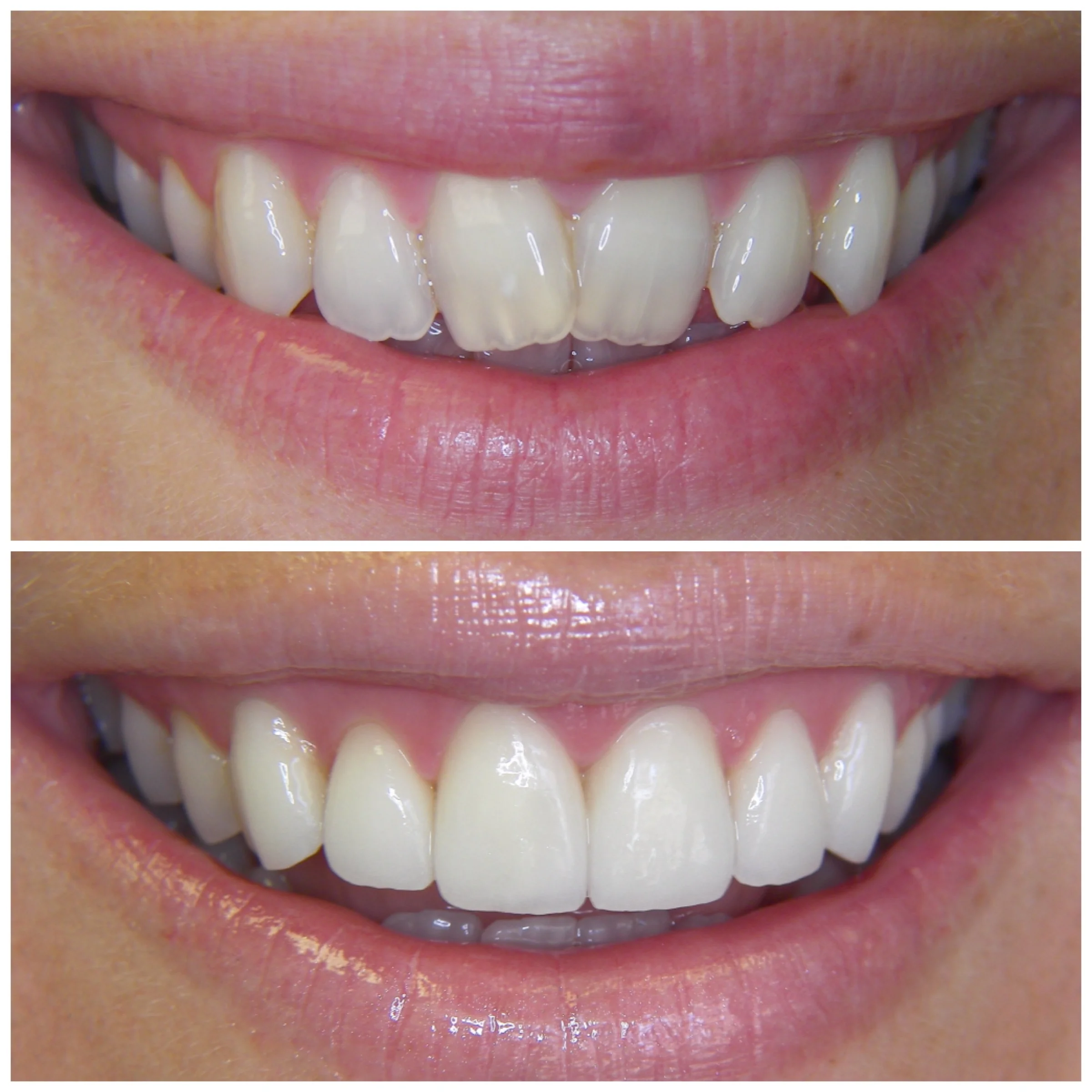 28 y.o. Female Treated With 6 Laminates