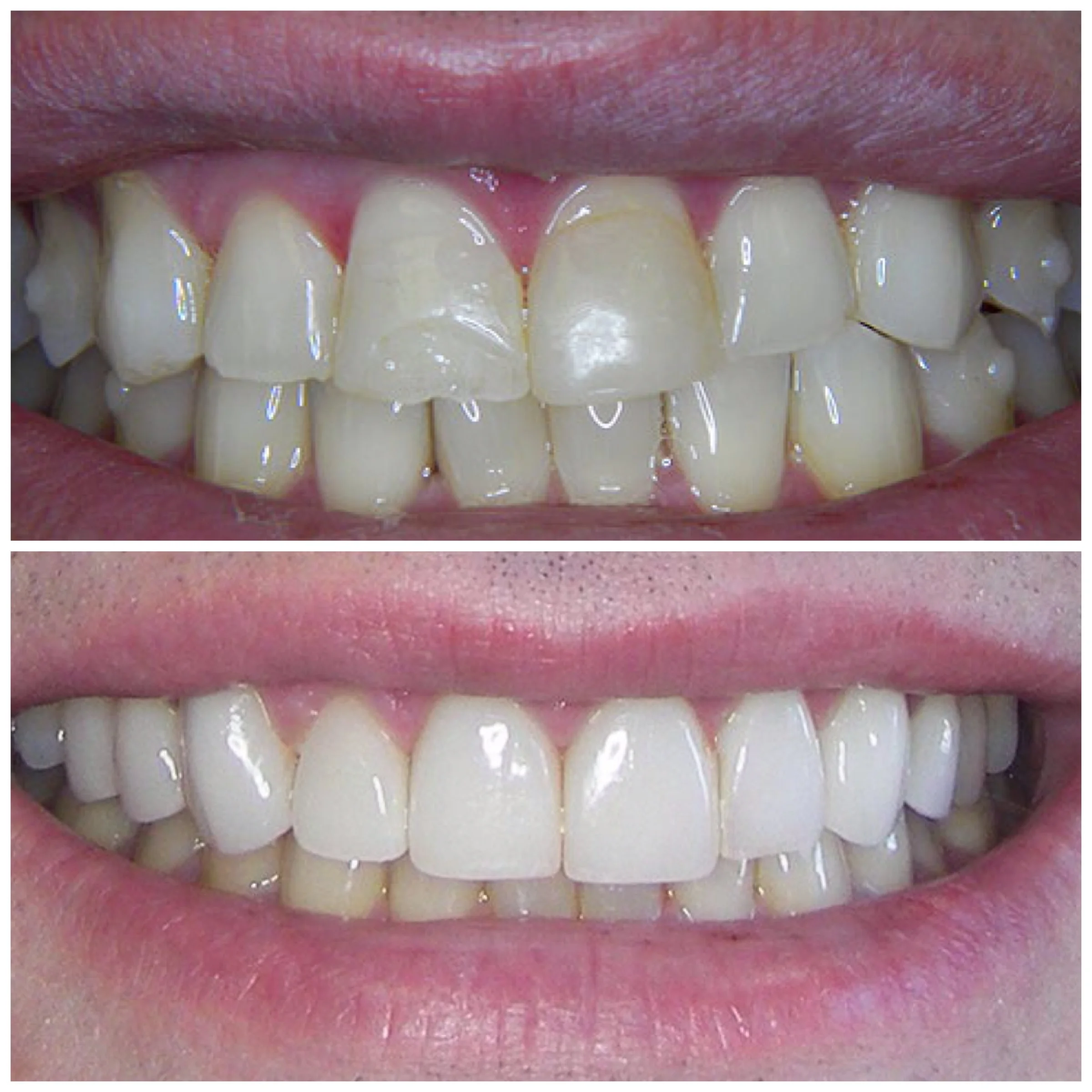 29 y.o. Male Treated With 20 Laminates And 4 Onlays