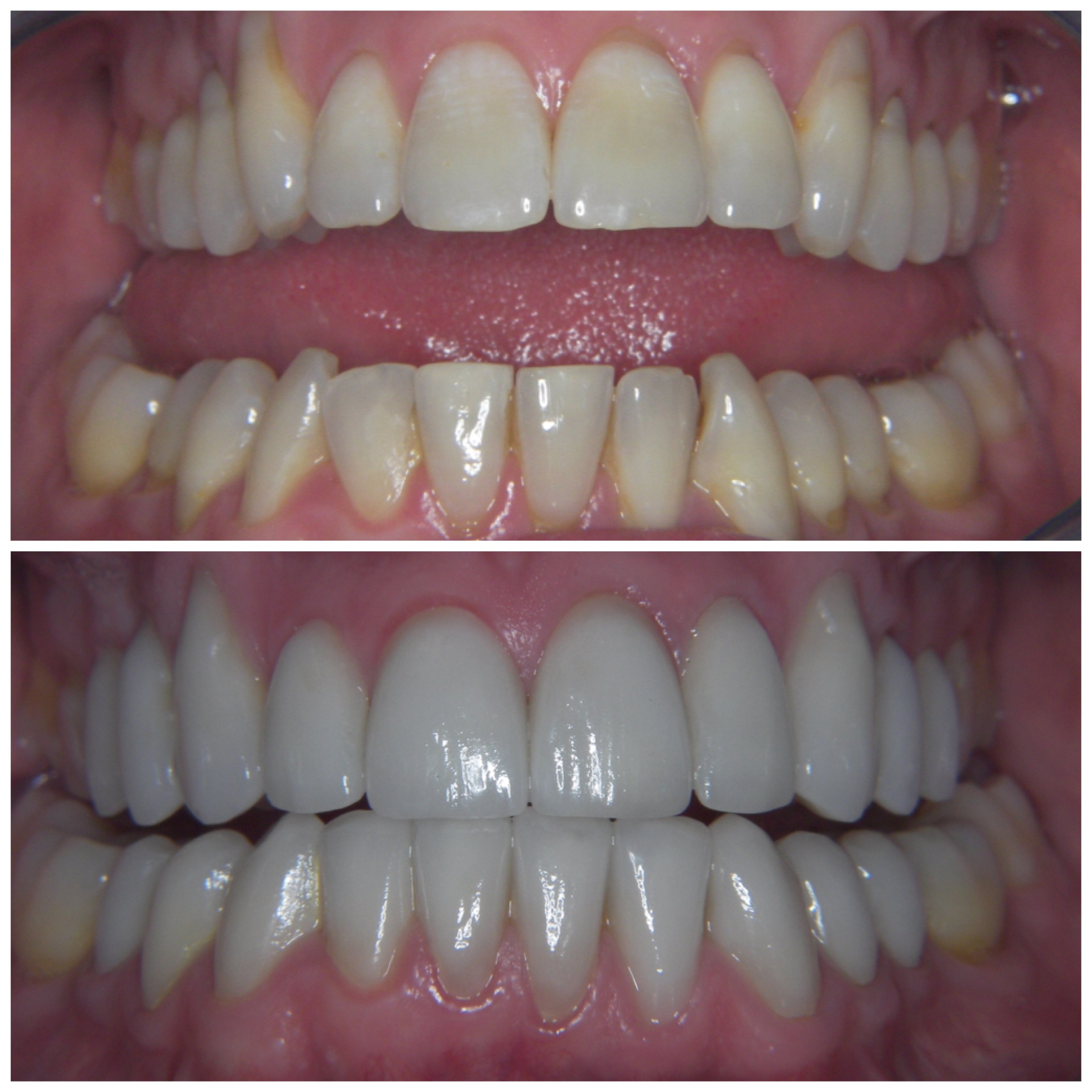 40 y.o. Males Treated With 20 Laminates