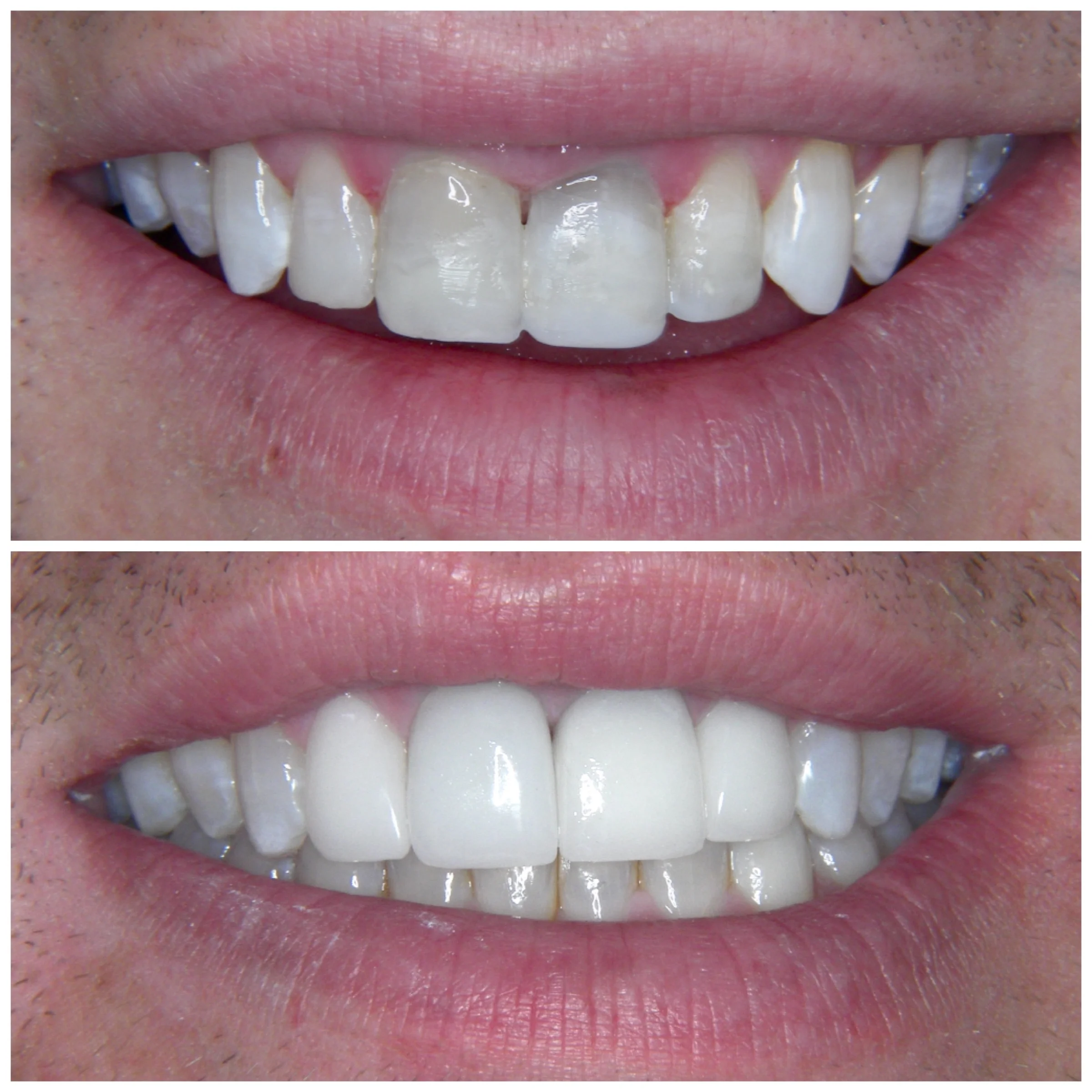 30 y.o. Male Treated With 2 Crowns and 4 Laminates