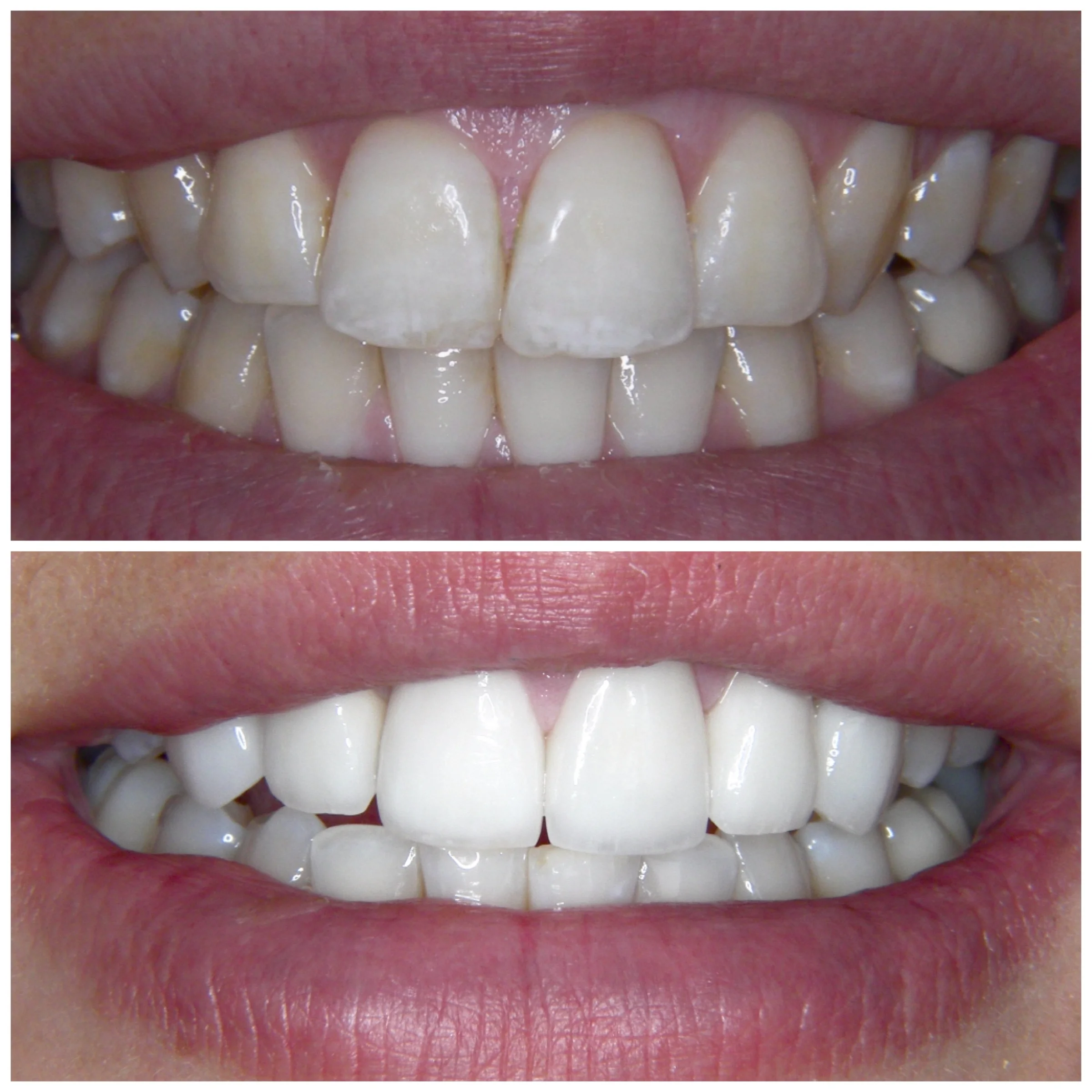 28 y.o. Female Treated With 6 Laminates