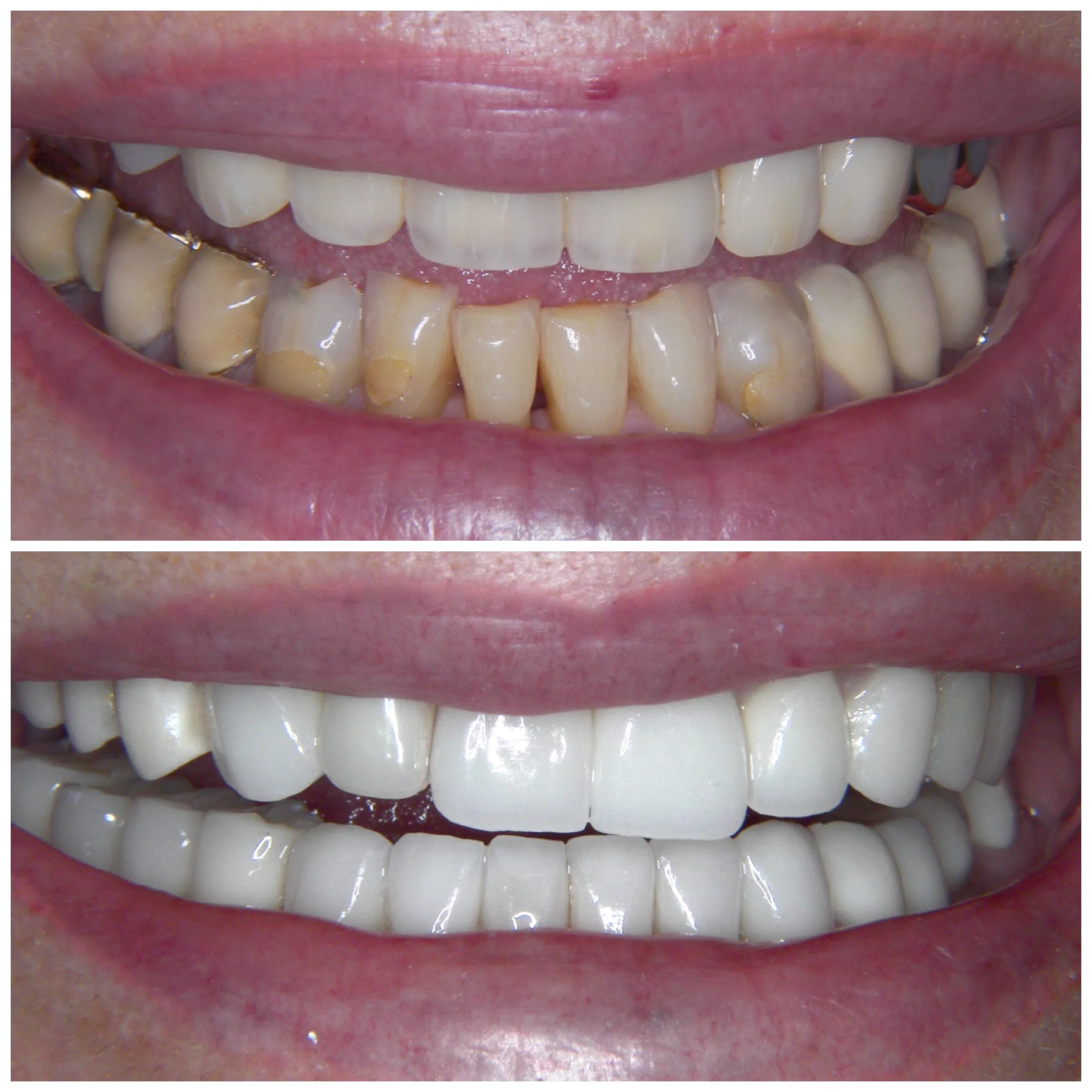 72 y.o. Female Treated With Laminates, Implants and Crowns