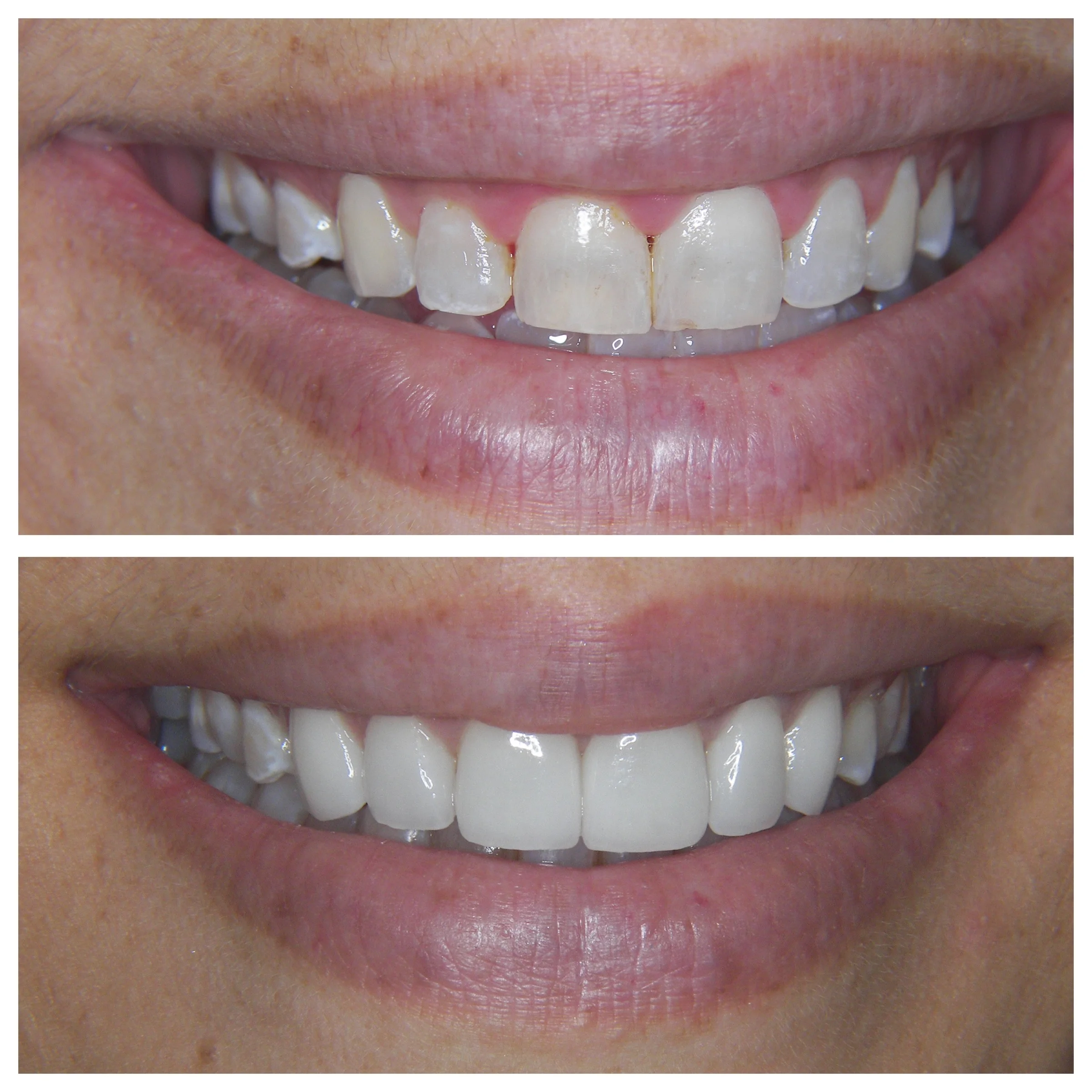 42 y.o. Female Treated With 6 Laminates + Lower Aligners