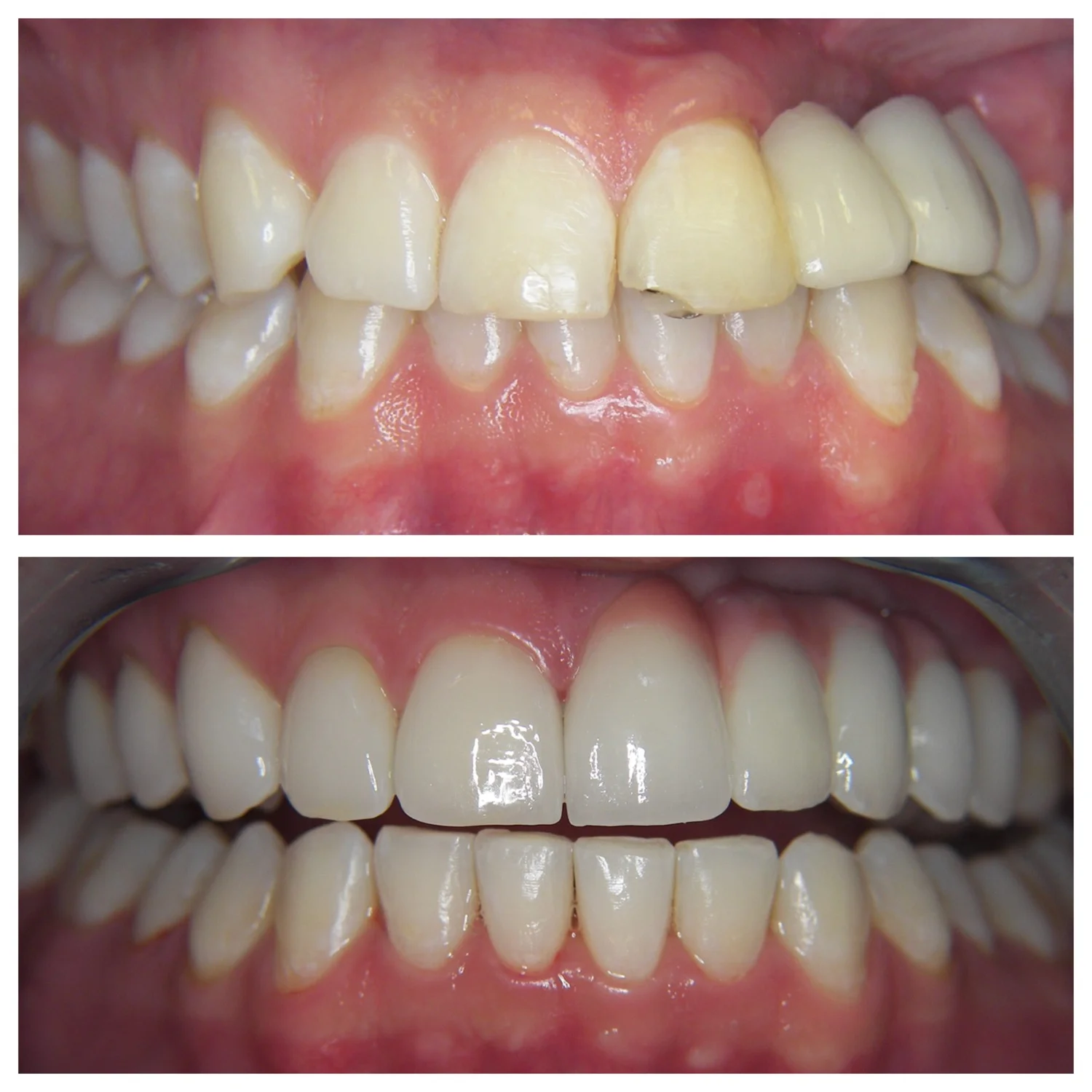 29 Yy.o. Male Treated With Aligners, Laminates, Implants, Crowns