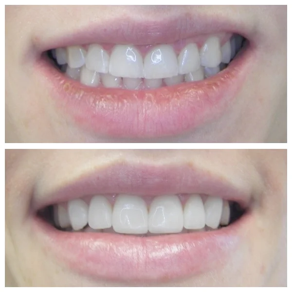 31 y.o. Female Treated With 12 Laminates And Onlays