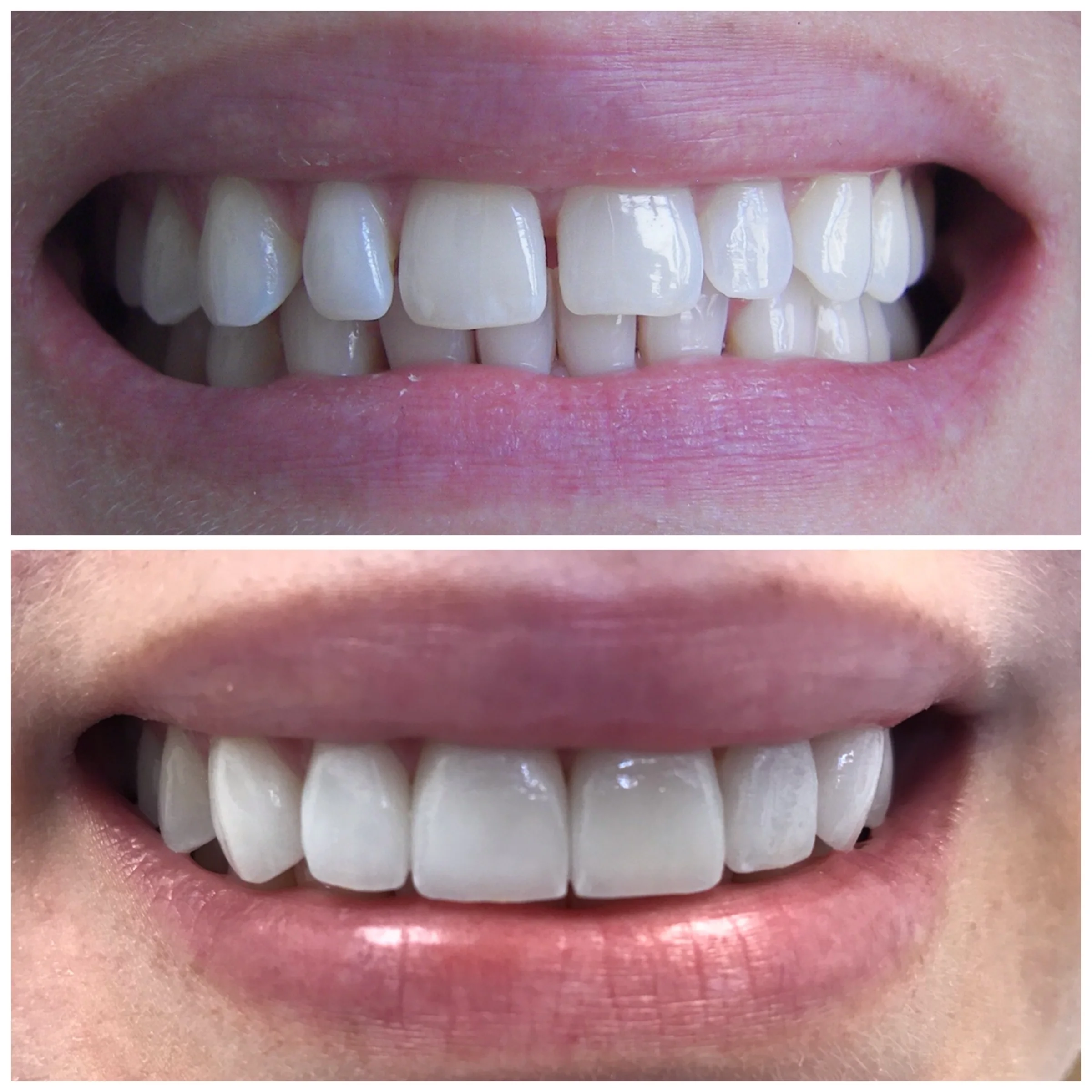 39 y.o. Female Treated With 6 Laminates