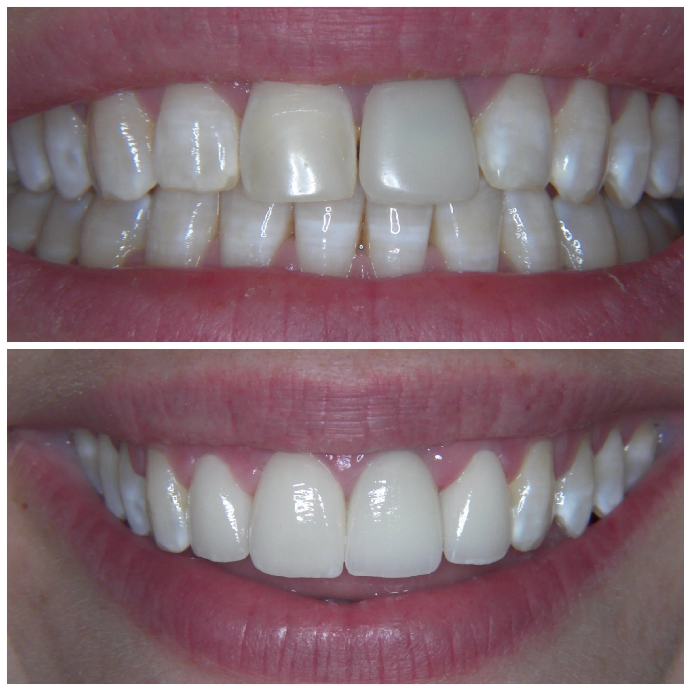 28 y.o. Female Treated With 4 Laminates