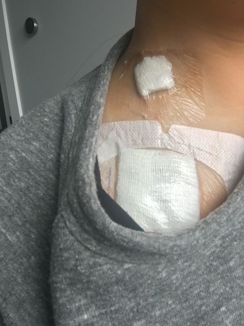 THE BANDAGE ON THE NECK WAS A SECOND INCISION SO THEY COULD PUT IN THE WIRE AND THEN CONNECT IT WITH THE ACTUAL PORT.