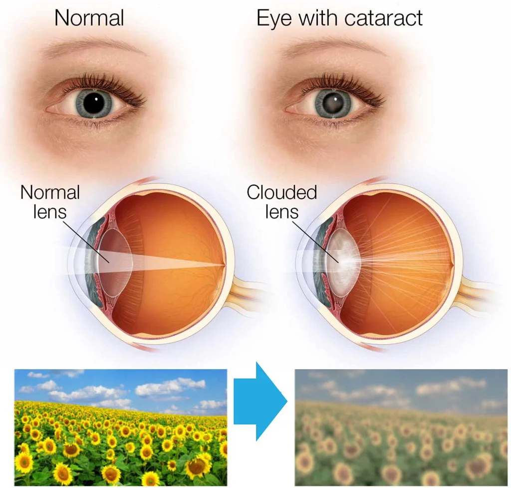 What Are The Symptoms Of Cataracts ICare Family Vision What Are The Symptoms Of Cataracts ICare Family Vision