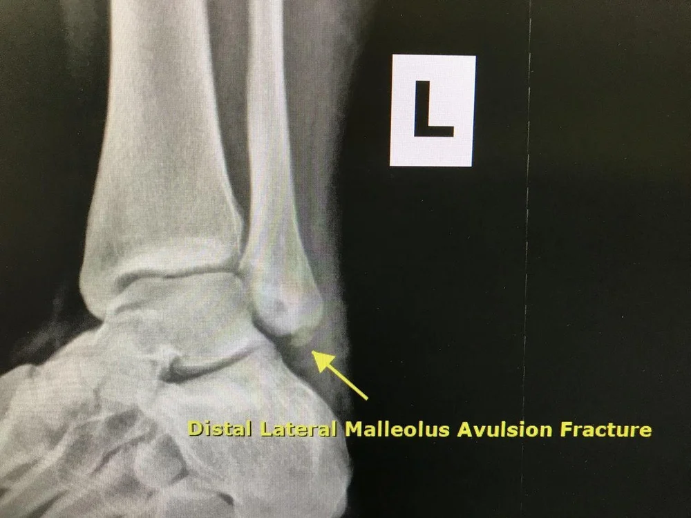 What Is Avulsion Fracture, How To Prevent And Rehabilitate It? — Best