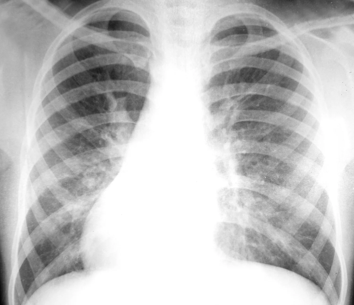 How To Self-Diagnose, Prevent And Rehab Rib Fracture. — Best Bainbridge ...