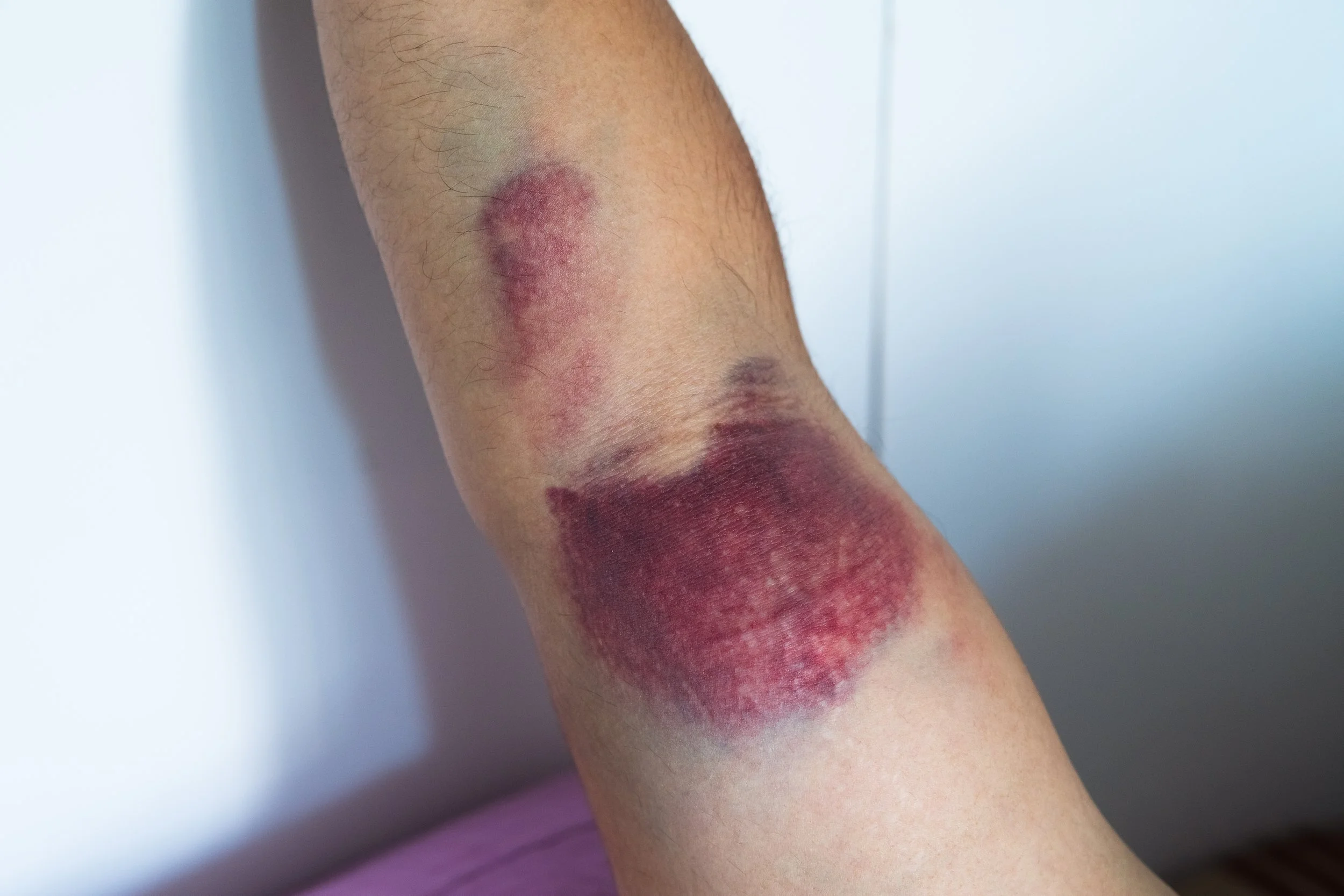 deep-bruising-physical-therapy