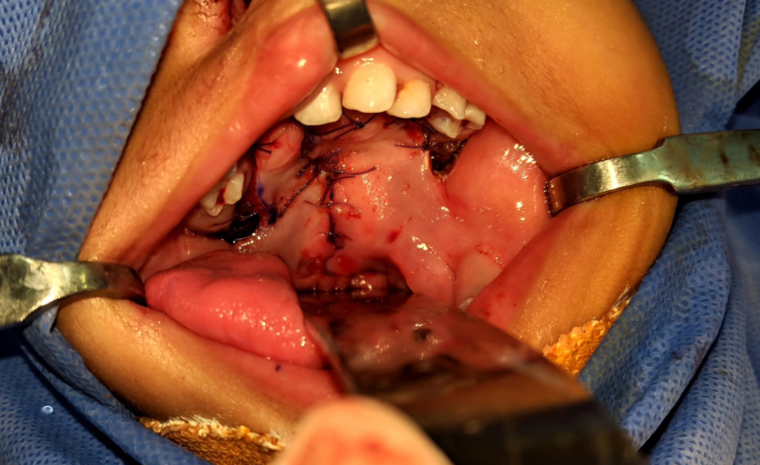 Closure of Cleft Palate