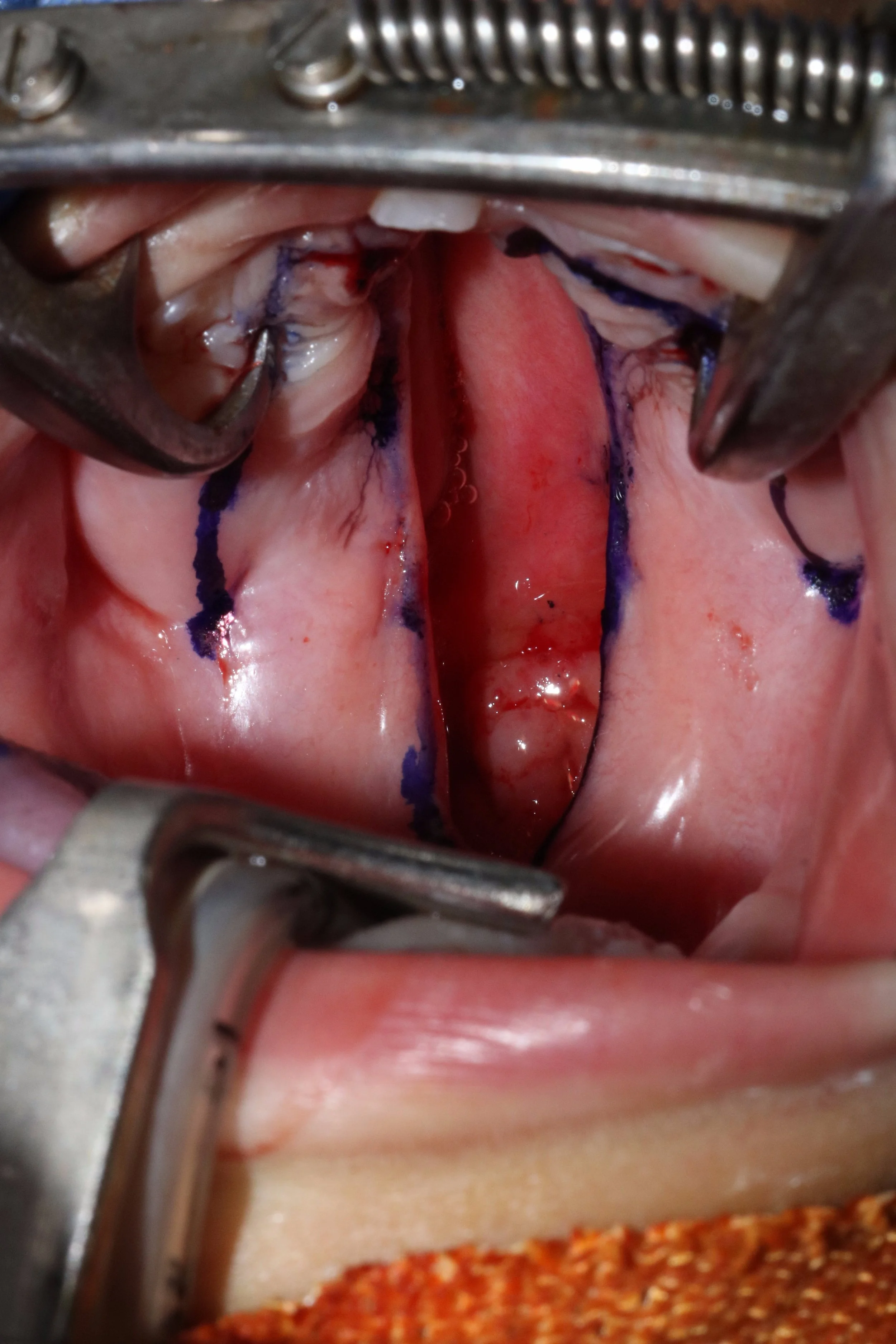 Primary Cleft of the Palate