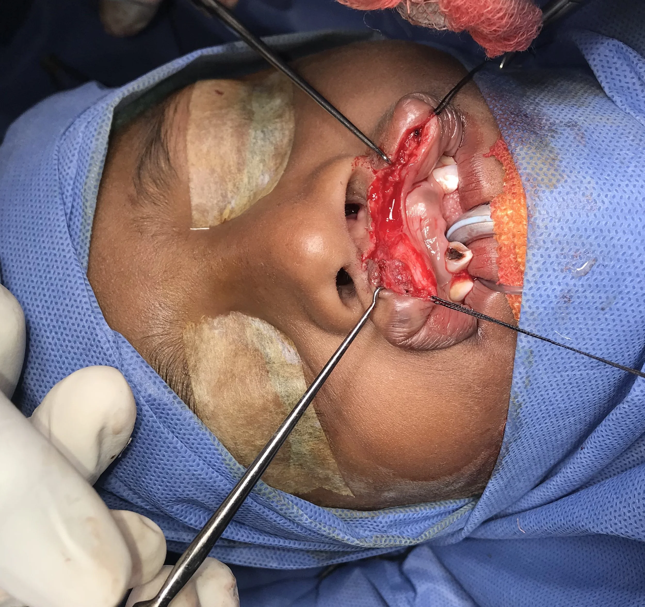 Intra-Operative