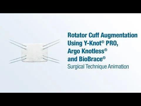 Rotator Cuff Augmentation Using Y-Knot® PRO, Argo Knotless®, and BioBrace® - CONMED Animation