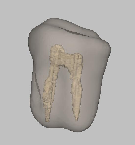 Guided Endodontics