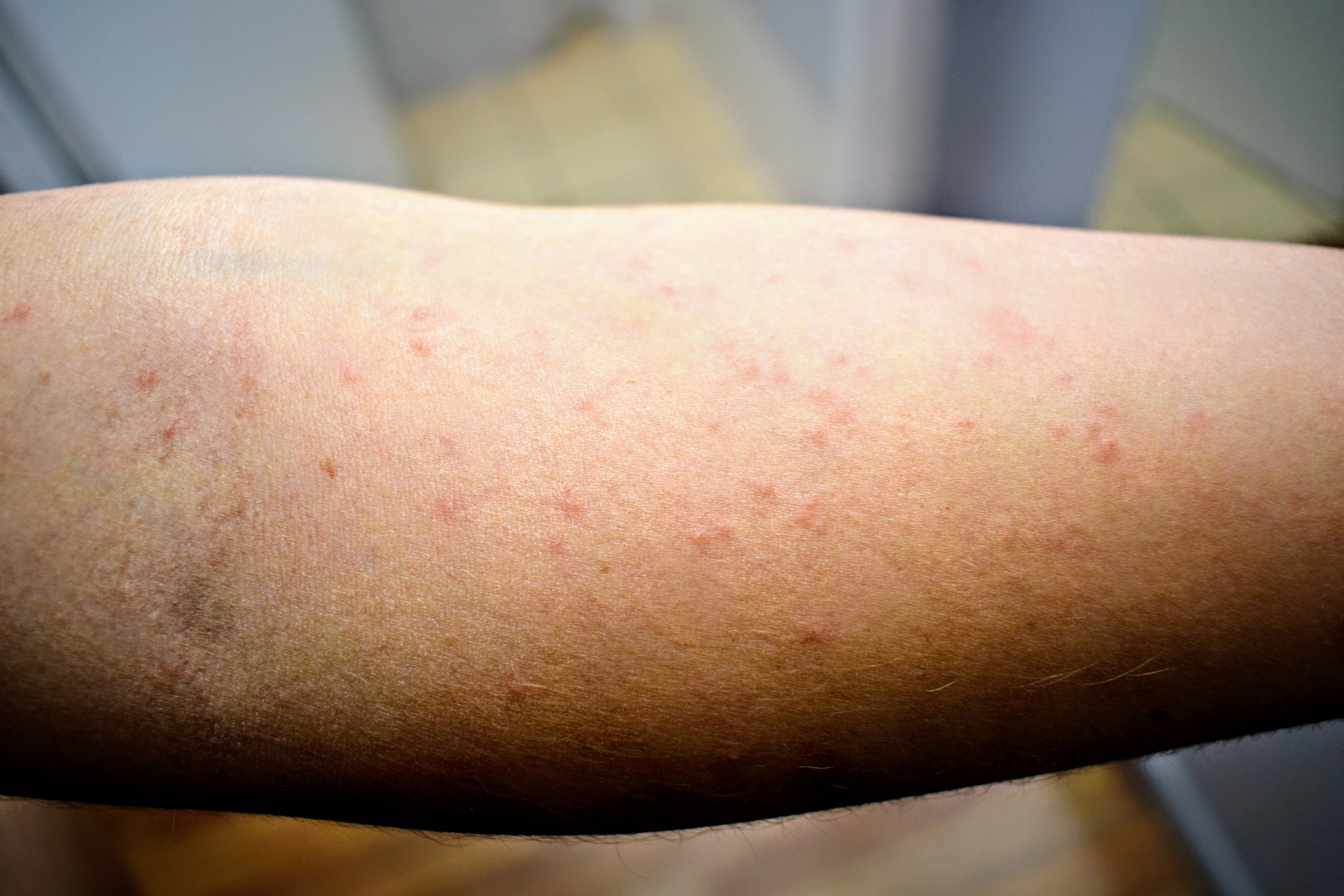 How To Deal With Scabies While Traveling Savvy Dispatches